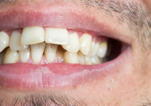 Who Can't Benefit from Invisalign Treatment?